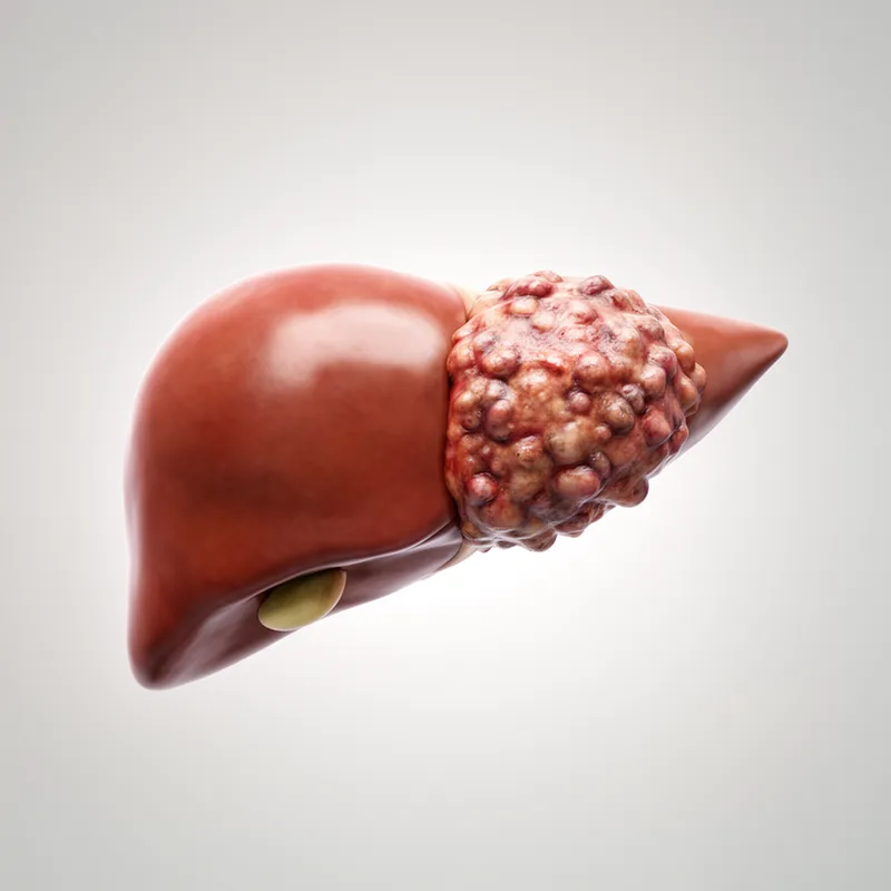 liver cancer