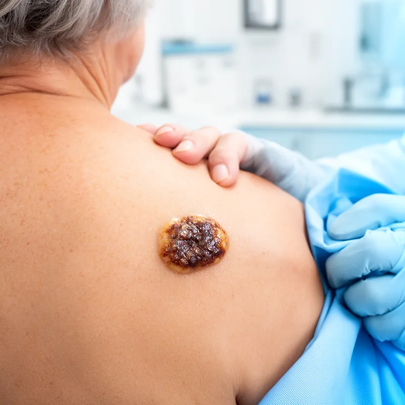 seborrheic keratosis