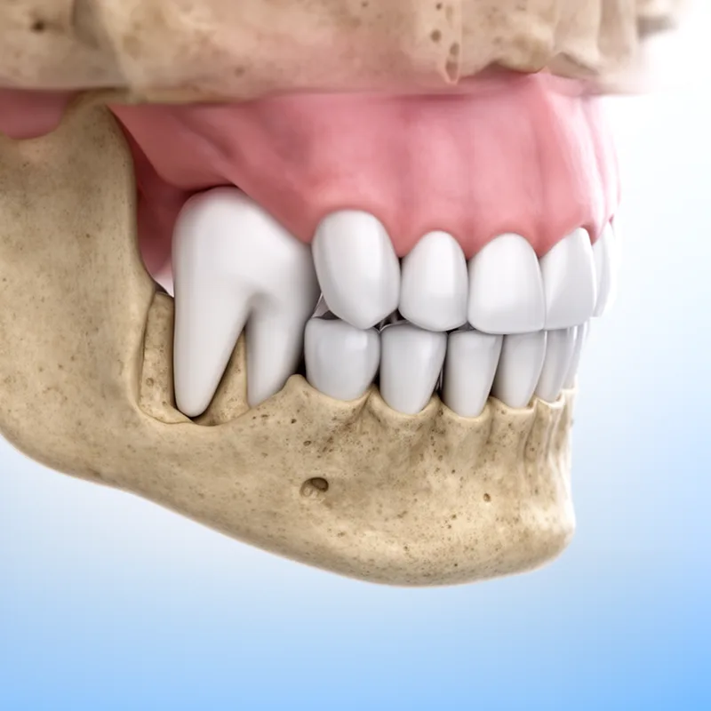 impaction