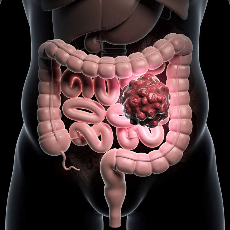 colon cancer