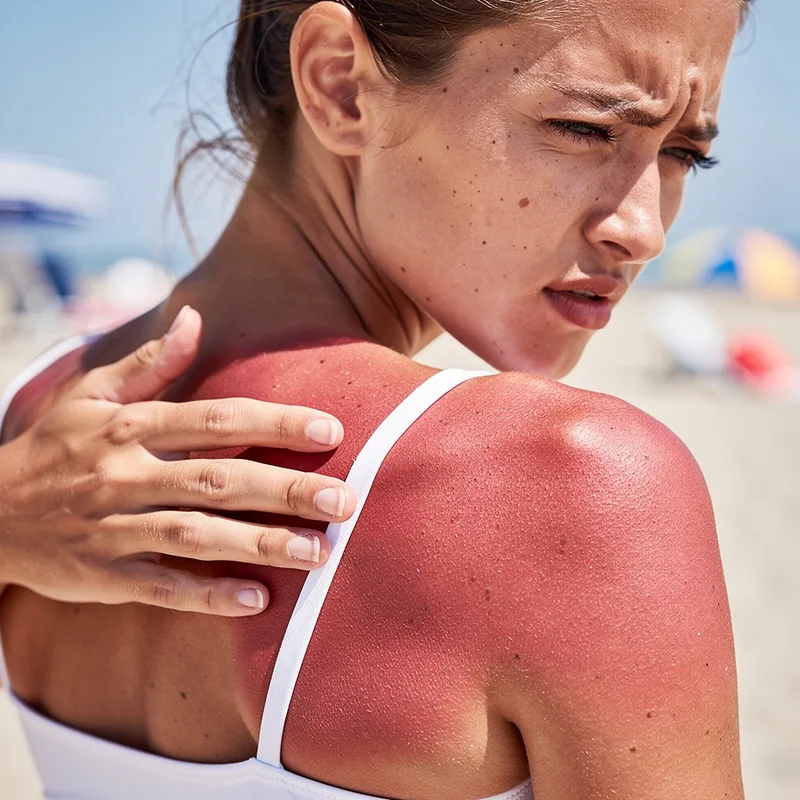 sunburn