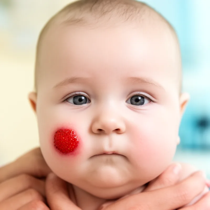 strawberry mark