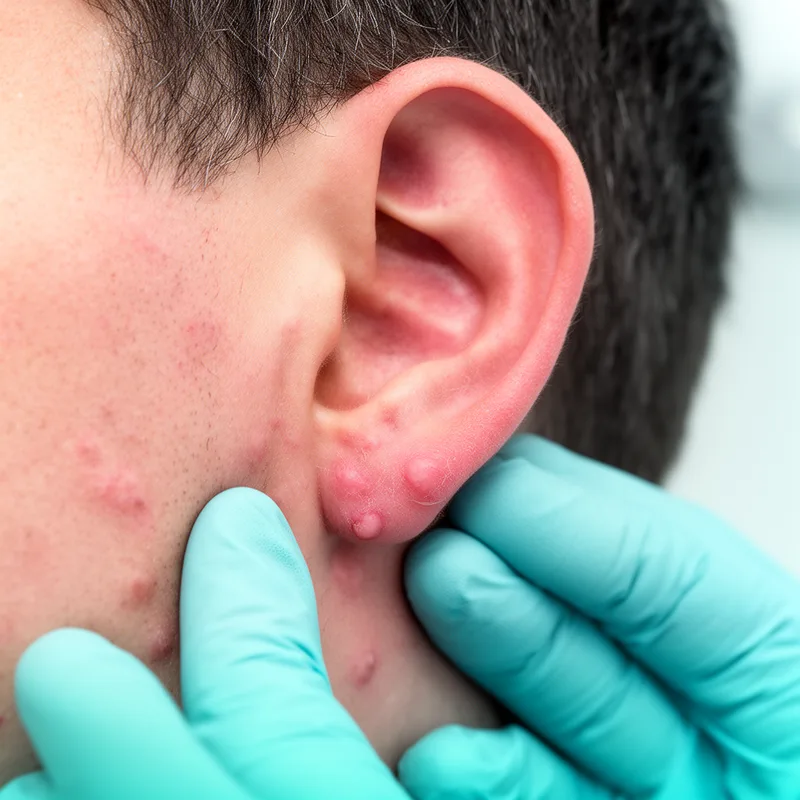 periauricular