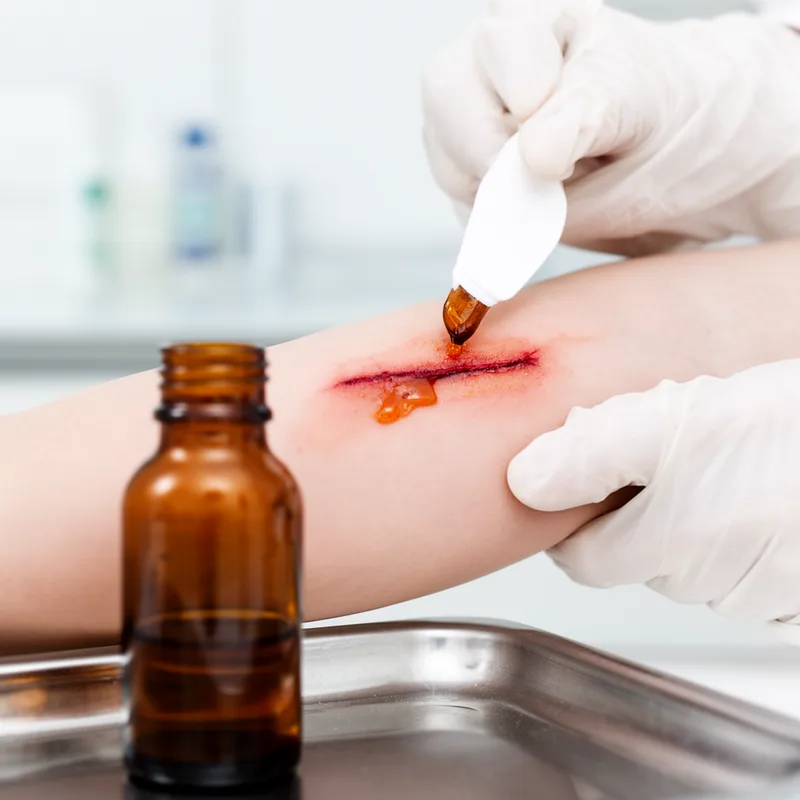 tincture of iodine