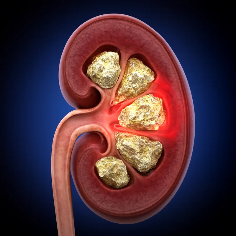 kidney stone
