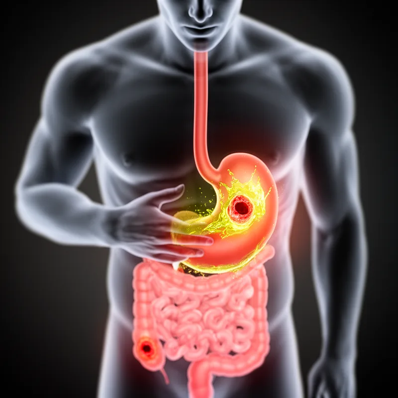 peptic ulceration