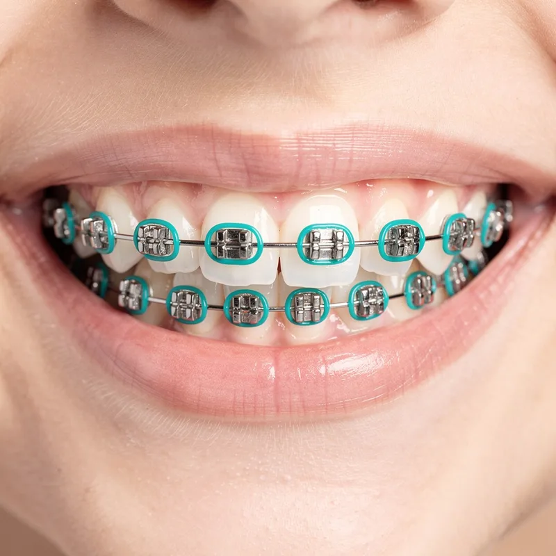 brace