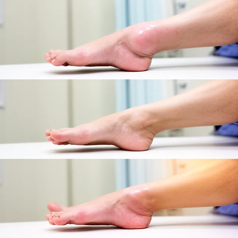 periodic edema