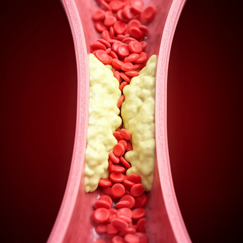 atheroma