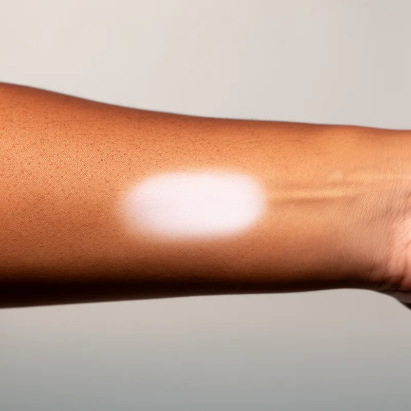 hypopigmentation