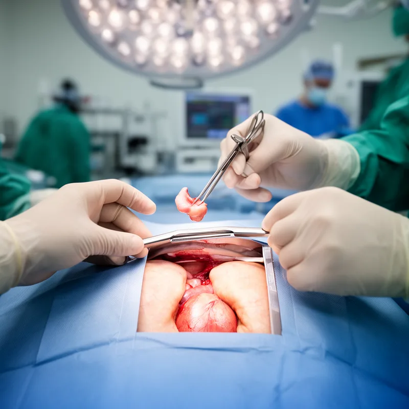 thymectomy