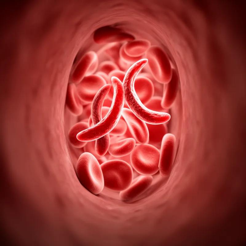 sickle cell