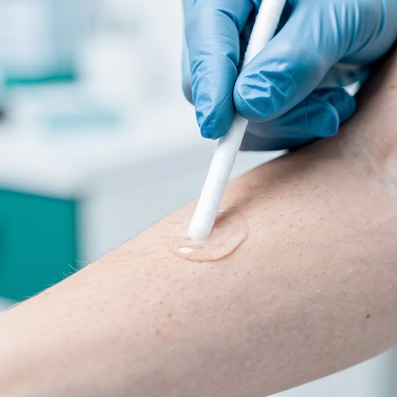 lidocaine