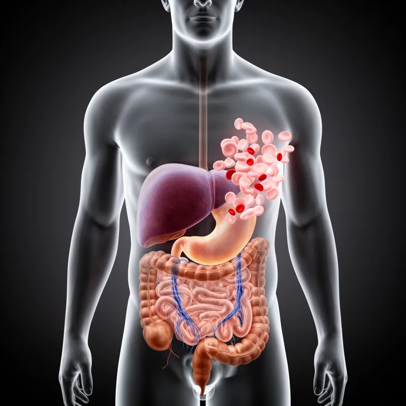 Banti's syndrome
