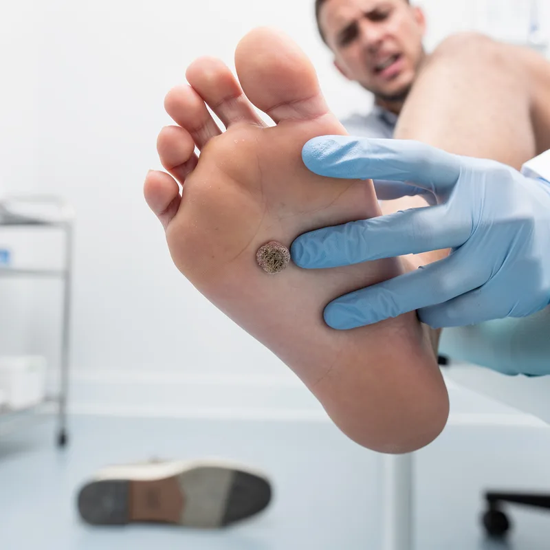 plantar wart