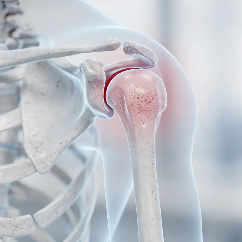 subluxation