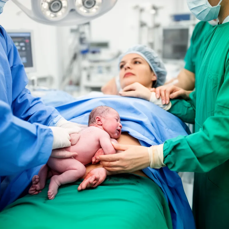 Caesarian delivery