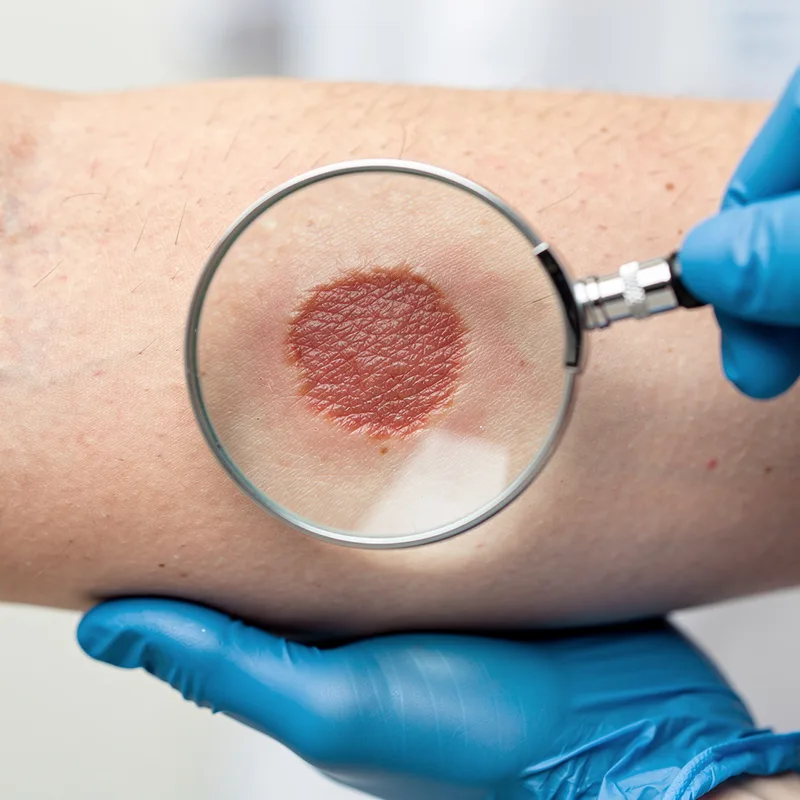 lesion
