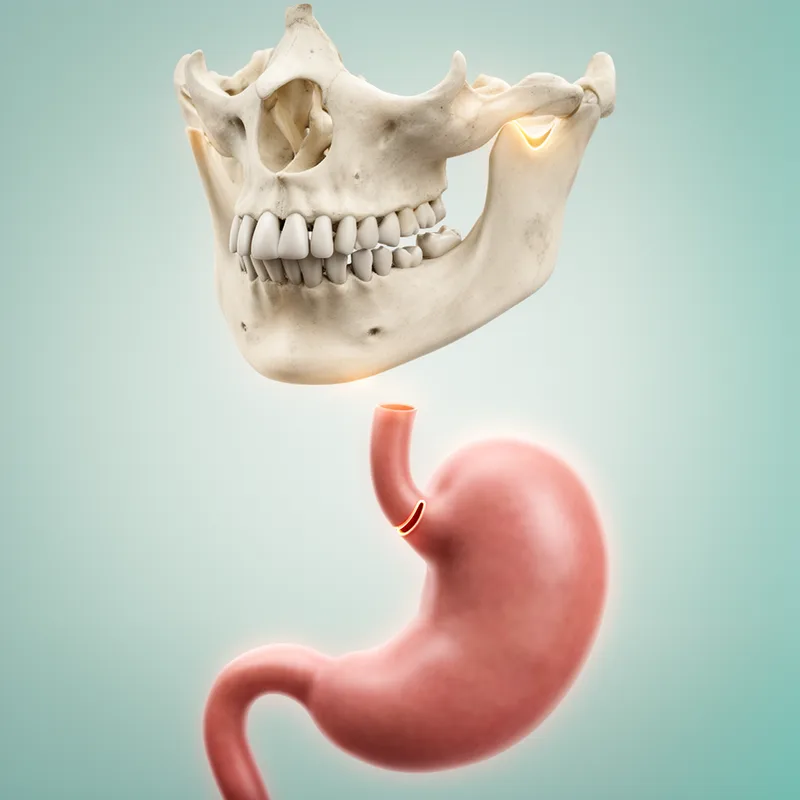incisura