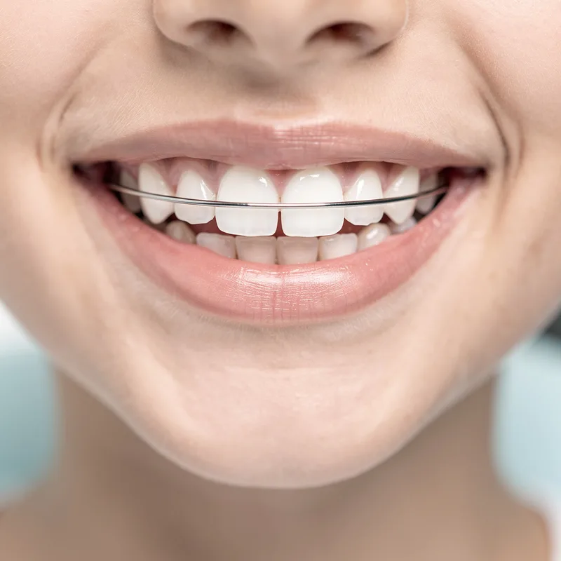 retainer