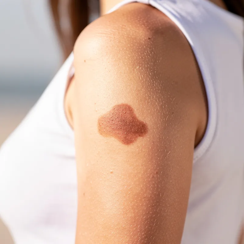 birthmark